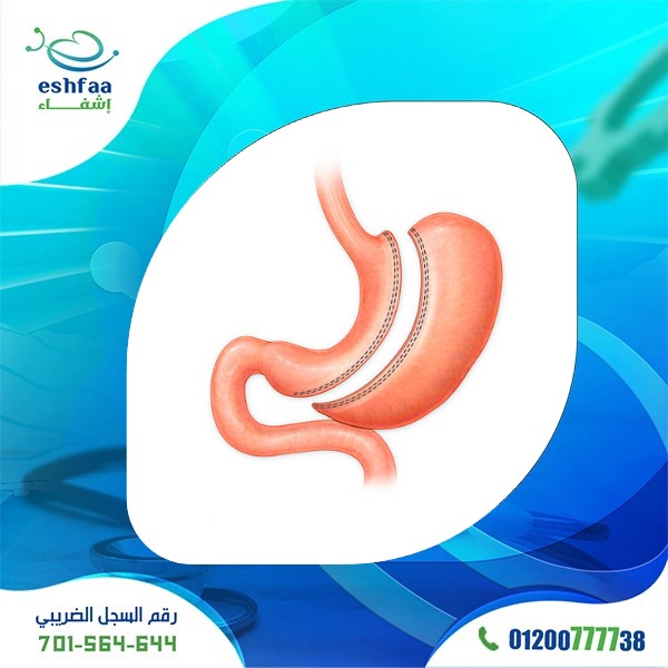 عملية تكميم المعدة